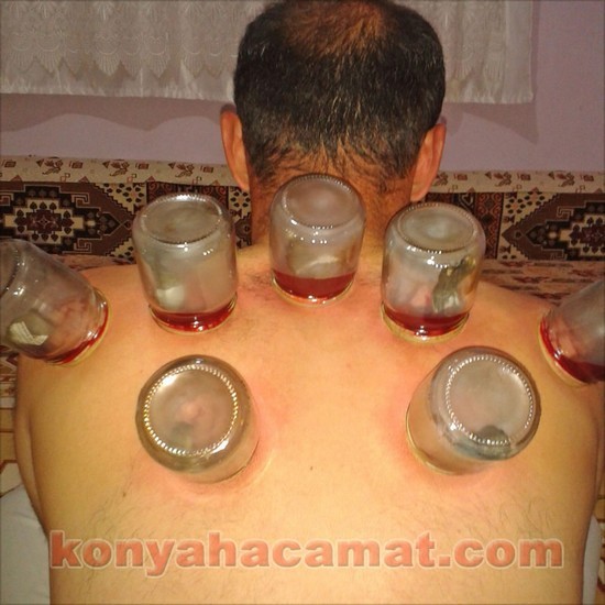 KESKİNOĞLU hacamat tedavisi sülük kursu Konya