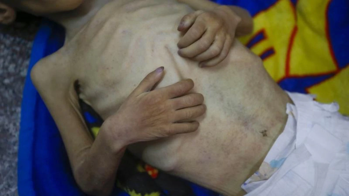 Gazze'de a&ccedil;lıktan &ouml;lenlerin sayısı 367'ye &ccedil;ıktı